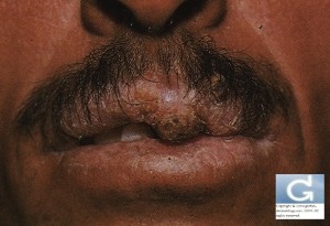 Carcinome Spinocellulaire (lèvre)
