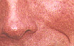 clint eastood telangiectasia close up