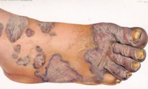 sarcoidosis kaposi handatlas der hautkrankheiten 1900