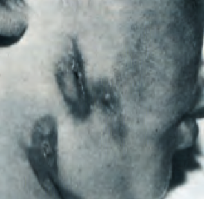 scrofuloderma the last one diagnosed in geneva in 1986
