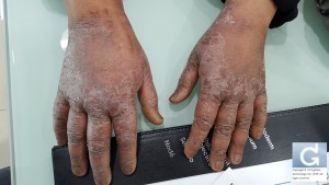 hand eczema after chemo