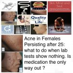 Acne In Females Persisting After 25: What To Do When Lab Tests Show Nothing. Is Medication The Only Way Out ?