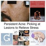 Persistent Acne: Picking At Lesions To Relieve Stress