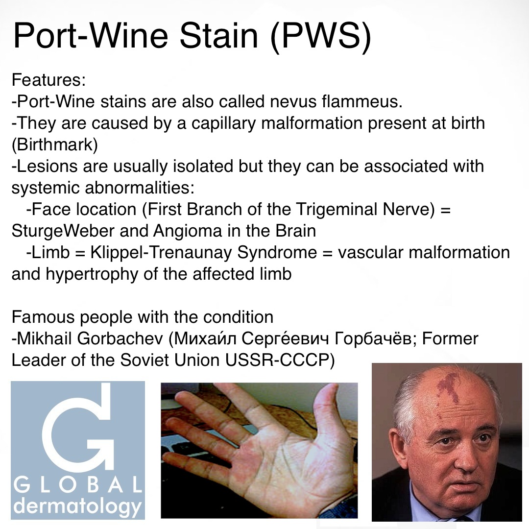 port wine stain
